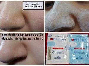 Mặt nạ trị mụn