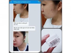 Đặc Trị Mụn Spl Princess White