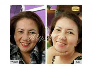Kem Đặc Trị Nám My Miu