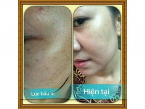 Kem Đặc Trị Nám My Miu