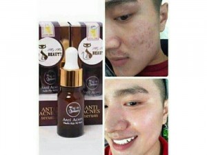 Trị mụn my miu