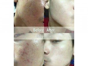 Trị mụn my miu