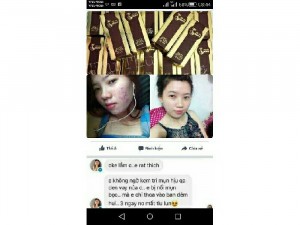 Trị mụn my miu