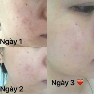 Bộ Đôi Trị Mụn Hiệu Quả_ Kem Trị Mụn Thảo Dược M' White, Hết Mụn Nhanh Chóng