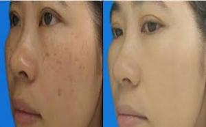 Điều trị nám, đốm nâu, tàn nhang sắc tố da không đều màu bằng phương pháp lăn kim kết hợp vói Cao Vua Hồng Sâm