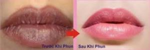 Dịch vụ xử lý môi thâm 60 phút