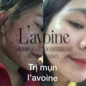 Trị mụn tận gốc từ thiên nhiên