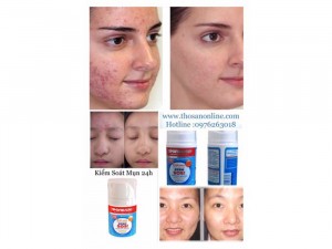CHỐNG MỤN siêu nhanh kéo dài 24h và là cơ sở dưỡng da trị thâm hiệu quả.Kem được thiết kế đặc biệt để ngăn chặn sự xuất hiện của mụn cám và mụn đầu đen.