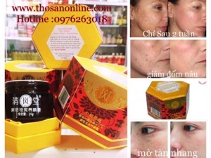Nám da thường xuất hiện ở độ tuổi trung niên đặc biệt tập trung ở hai bên má, trán, mũi. Nguyên nhân gây nám có thể là do yếu tố di truyền, sự thay đổi nội tiết tố (mang thai, mãn kinh), do các bệnh phụ khoa như viêm nhiễm, viêm tử cung..., stress, yếu tố môi trường, hay dùng mỹ phẩm không phù hợp.