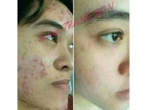 Combo trị thâm và nám tàn nhan cao cấp trang bon