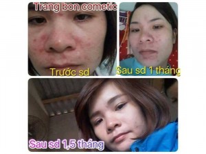 Combo trị thâm và nám tàn nhan cao cấp trang bon