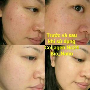 Ảnh mô tả da của khách trước và sau khi xử dụng gel NC24
