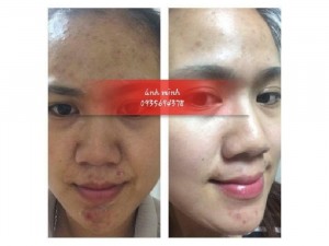 Ashi acnes