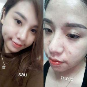 Mặt nạ nhau thai cừu Hàn Quốc có trị được nám da không?