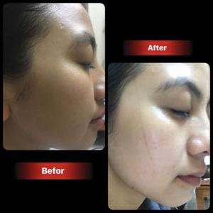 Mặt nạ nhau thai cừu Hàn Quốc có trị được nám da không?