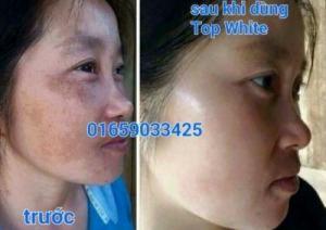 Xóa tan nỗi lo nám da, da đen sạm, thô sần với kem dưỡng trắng da, tái tạo trẻ hóa Top White D1