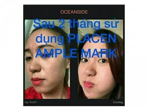 Mặt nạ nhau thai cừu