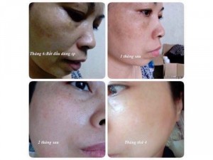 Viên uống trị nám vitamin E và 6000 lần vitamin C