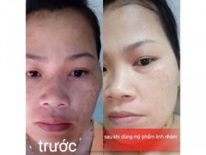 Kem Trị Nám Linh Nhâm