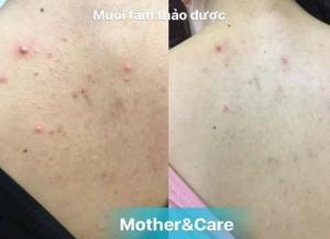 Muối Tắm Trị Viêm