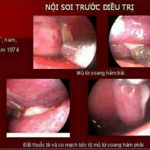 Sản phẩm hỗ trợ trị viêm xoang