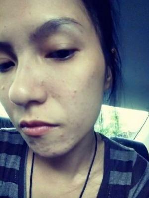 Bột cám gạo thảo dược Anthy hỗ trợ điều trị mụn