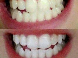 Bột trắng răng