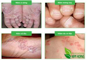 Hỗ trợ đặc trị nấm gia truyền Nam Hoàng