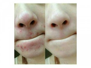Combo trị mụn Princess_white
