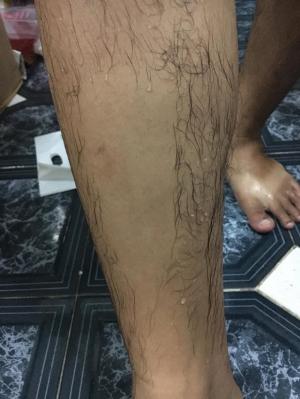 Kem Tẩy Lông Nấm