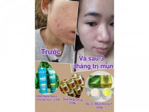Bộ trị mụn MOCHA