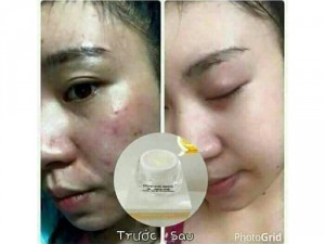 Kem đặc trị mụn