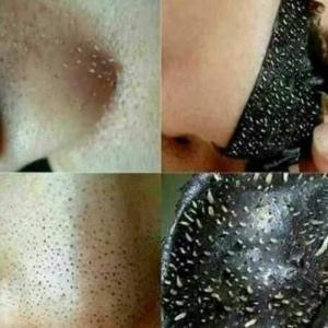 Gel lột mụn Lê Thanh