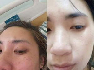 Kem đặc trị nám- tàn nhang- đồi mồi