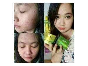 Trị mụn Đông y MoCha