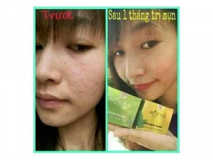 Trị mụn Đông y MoCha
