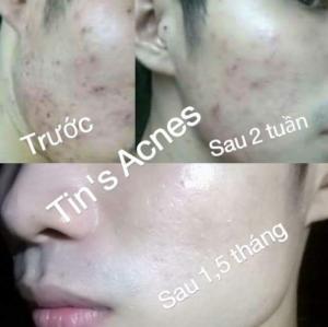 Thảo Dược Trị Mụn Thiên Nhiên