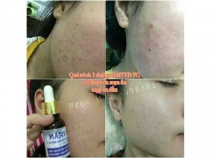 Mỡ Trăn Thảo Dược