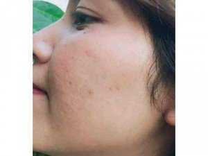 Trị mụn tận gốc TRẦN KIM HUYỀN