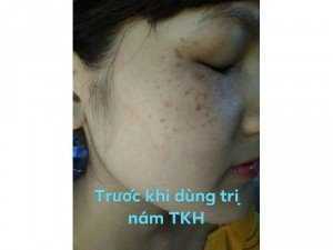 Đặc trị nám TRẦN KIM HUYỀN