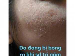 Đặc trị nám TRẦN KIM HUYỀN