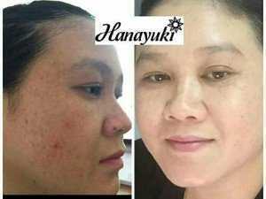 Serum Nám hanayuki (Hàn Quốc)