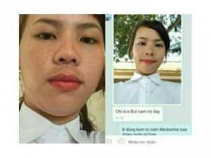 Kem trị nám