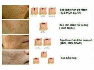 Kem trị sẹo rỗ