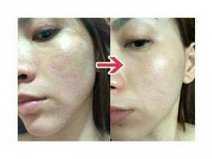 Kem trị sẹo rỗ