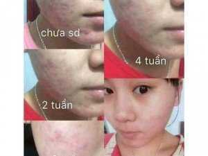 Đặc trị mụn tận gốc TKH