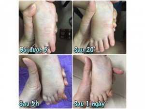 Dầu Thoa trị muỗi đốt