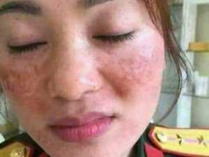 SẢn phẩm kem trị nám Mocha