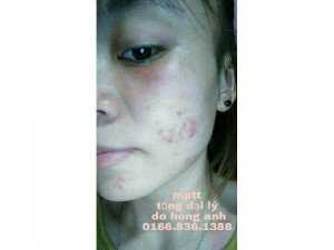 Trị mụn ,nám, sẹo rỗ ,tàn nhan