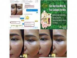 Combo trị nám